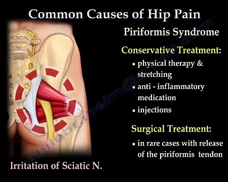 Sacroiliac Joint Dysfunction Animation - Everything You Need To Know - Dr. Nabil Ebraheim, M.D.