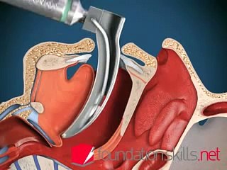 Entubação Medicina UFS 2007-2