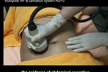 PORTABLE ULTRASONIC CAVITATION and RF MACHINE