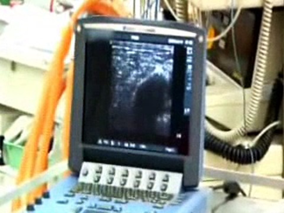 Ultrasound Use in Anaesthesia and Critical Care Medicine