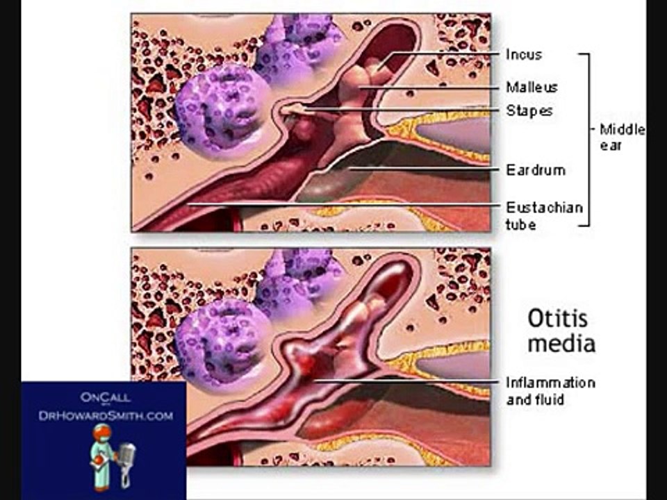 Tube Surgery Ear, Surgery for Kids - Surgery Indicators, On Call with Dr. Howard Smith