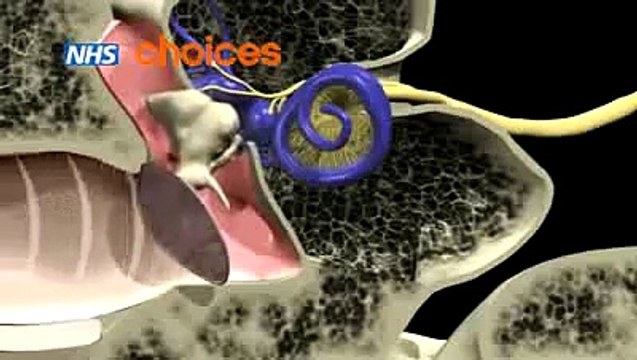 Otitis Media (Glue Ear) - II