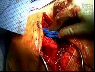 Reverse Delta Shoulder Replacement Part 2