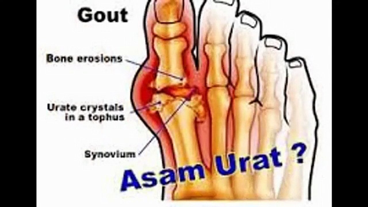 Obat Asam Urat Alami, Chitosan Herbal, Tiens Muncord Capsules dan Teh Tianshi Jiang Zhi Tea