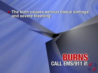 First Aid for Burns with Nick Rondinelli