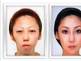 Cirugias esteticas coreanas ANTES Y DESPUES