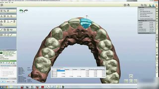 3D Orthodontic Treatment - K Line clear aligners
