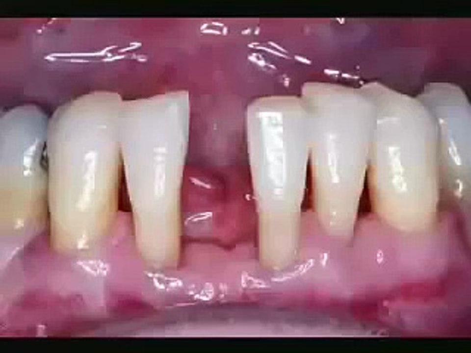 Single Visit Fiber Reinforced Fixed Bridge with Ribbond 1 of 2