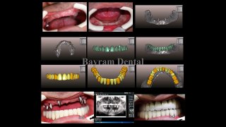 Bagcilar implant - Bayram Dental