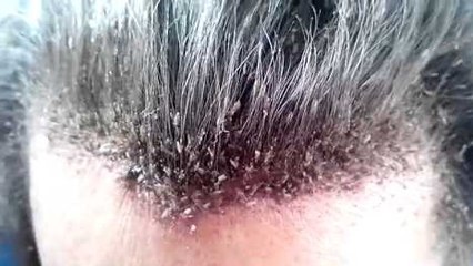 Hundreds of lice on the head
