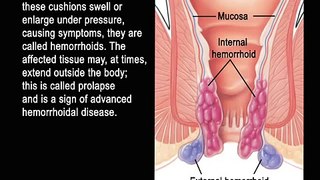 procedure for prolapsing hemorrhoids
