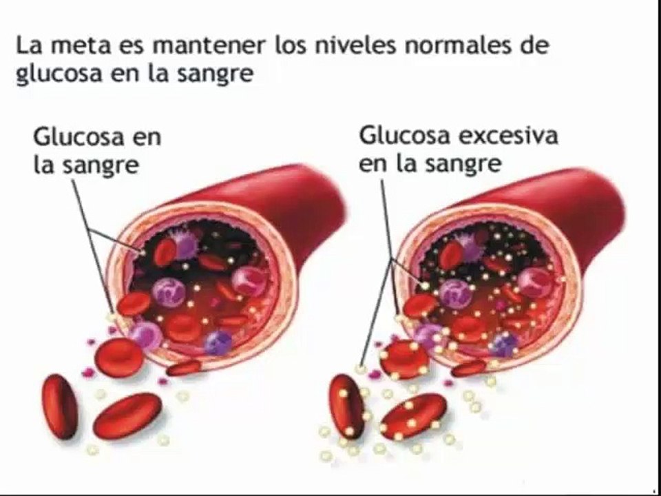 Diabetes Tipo 1 - Causas Sintomas Diagnostico