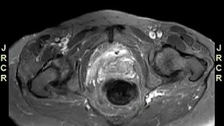 Radiology video: Synchronous primary tumors of the kidney and the ovaries: Imaging findings