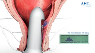 piles: HAL Hemorrhoidal Artery Ligation - new fast and painless treatment of haemorrhoids