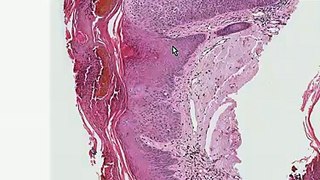Histopathology Skin--Actinic keratosis