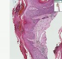 Histopathology Skin--Actinic keratosis