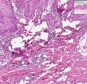Histopathology Skin-- Squamous cell carcinoma