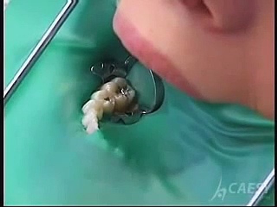 Root Canal Procedure