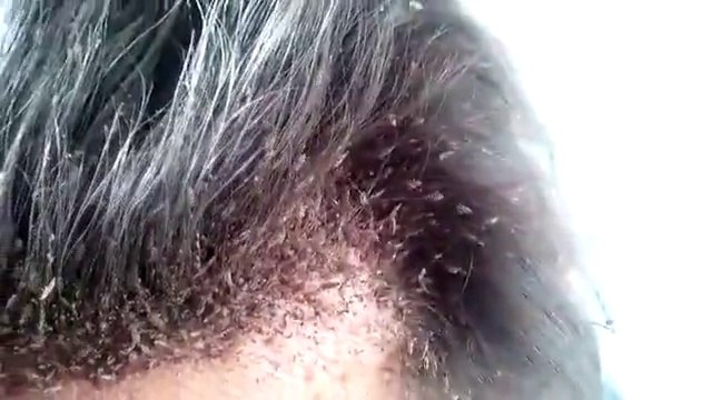 Woman has head lice infestation... EURK