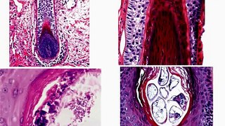 Dermatopathology101-Normal skin histology, non-neoplastic skin disorders, and skin cancers.mov