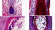 Dermatopathology101-Normal skin histology, non-neoplastic skin disorders, and skin cancers.mov
