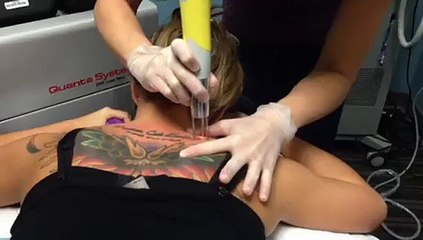 Tatto Removal