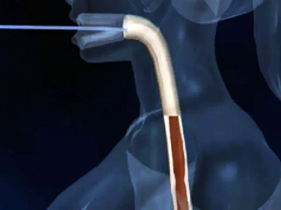 Gastric Ballon