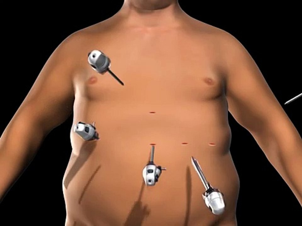 Gastric Band