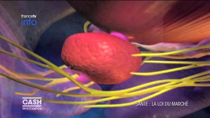 Cash Investigation. Ecoutez le "Hop 50", le classement des hôpitaux accros au bistouri