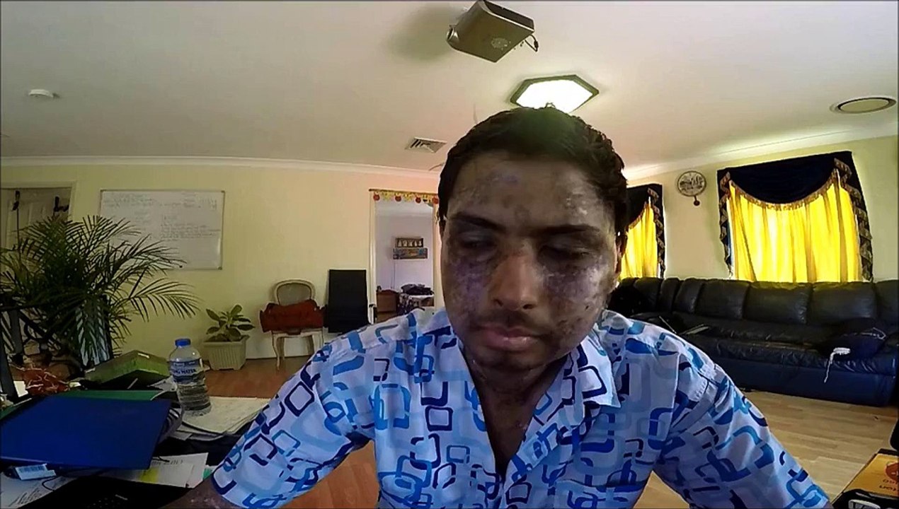 So I'm Partially Blind Now...