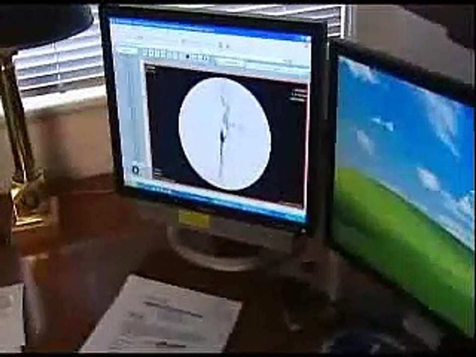 New Stent Procedure Safer