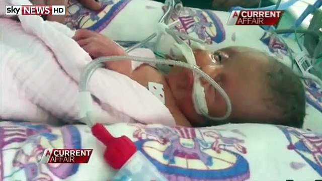Mom Gives Birth To Conjoined Twins, Baby With Two Faces, After Refusing Abortion