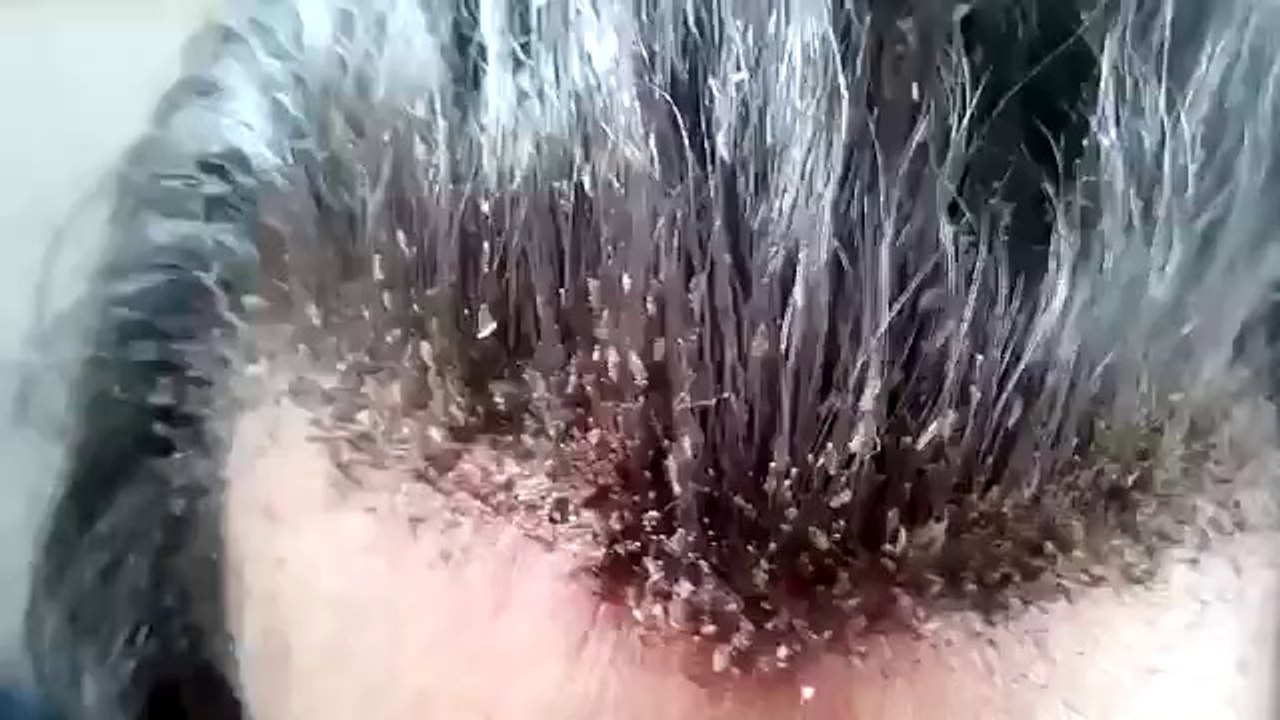 Oh No: Dude Has A Major Hair Lice Infestation!