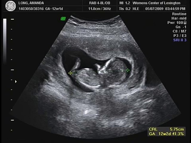 12 Weeks 1 Day Ultrasound Video Dailymotion