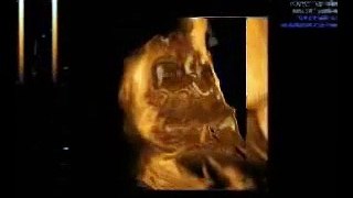 Ultrasound 4D - La Meva Petita Estrella
