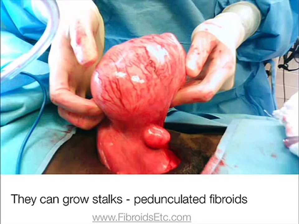 Submucosal Fibroid