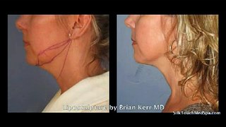 Liposuction Before and After of Neck Area | Silk Touch Medical Aesthetics, Boise