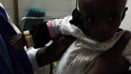 16 month old girl with malnutrition,no expression,chronic diarrhea and mom wanted to take him home