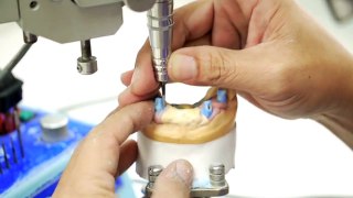 K Dental Lab-Implant-1.mov