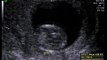Ultra-som 12 semanas do baby de Leandro e Karla