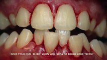 Bleeding and Swollen Gums. Dr Kuljeet MEHTA-Periodontist.