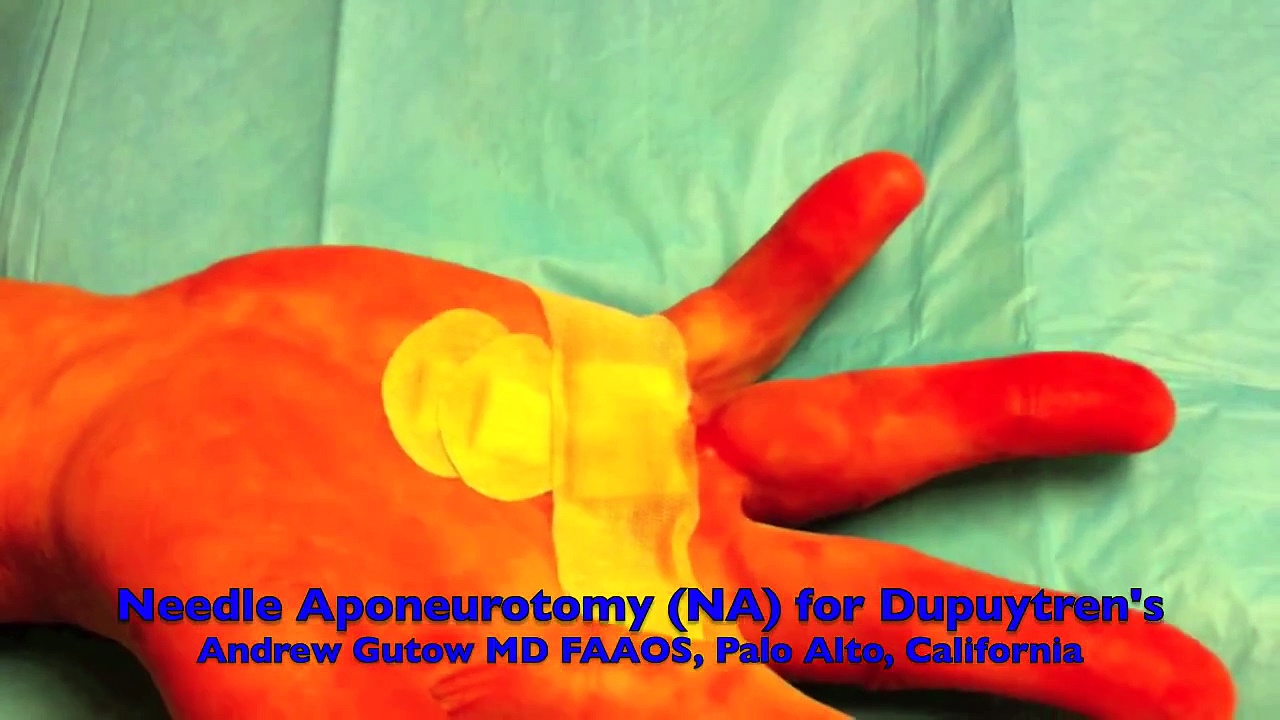 Office Treatment of Dupuytren's Contracture Needle Aponeurotomy and Xiaflex Injection