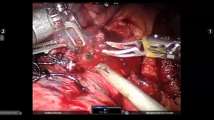 Robotic Pulmonary Lobectomy for Lung Cancer: in the fissure or fissureless