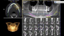 Dental implants & Cone Beam (CBCT) for general dentists - markers
