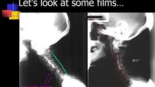 Upper Cervical x ray films