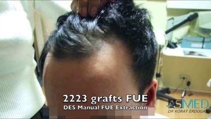 ASMED Dr. Koray Erdogan, 1800 grafts. DES Manual FUE