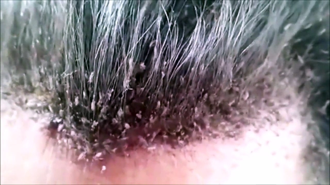 This head lice infestation will make your skin crawl video Dailymotion