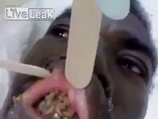 Maggots inside mans mouth