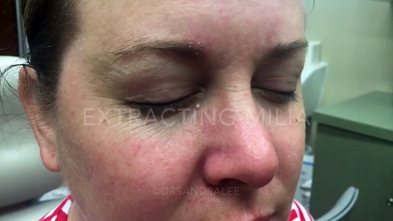 Extracting-a-Milia-under-the-eye