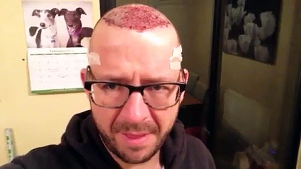 David Patient Journey Hair Transplant - Day 1 - The After ‘Effects'